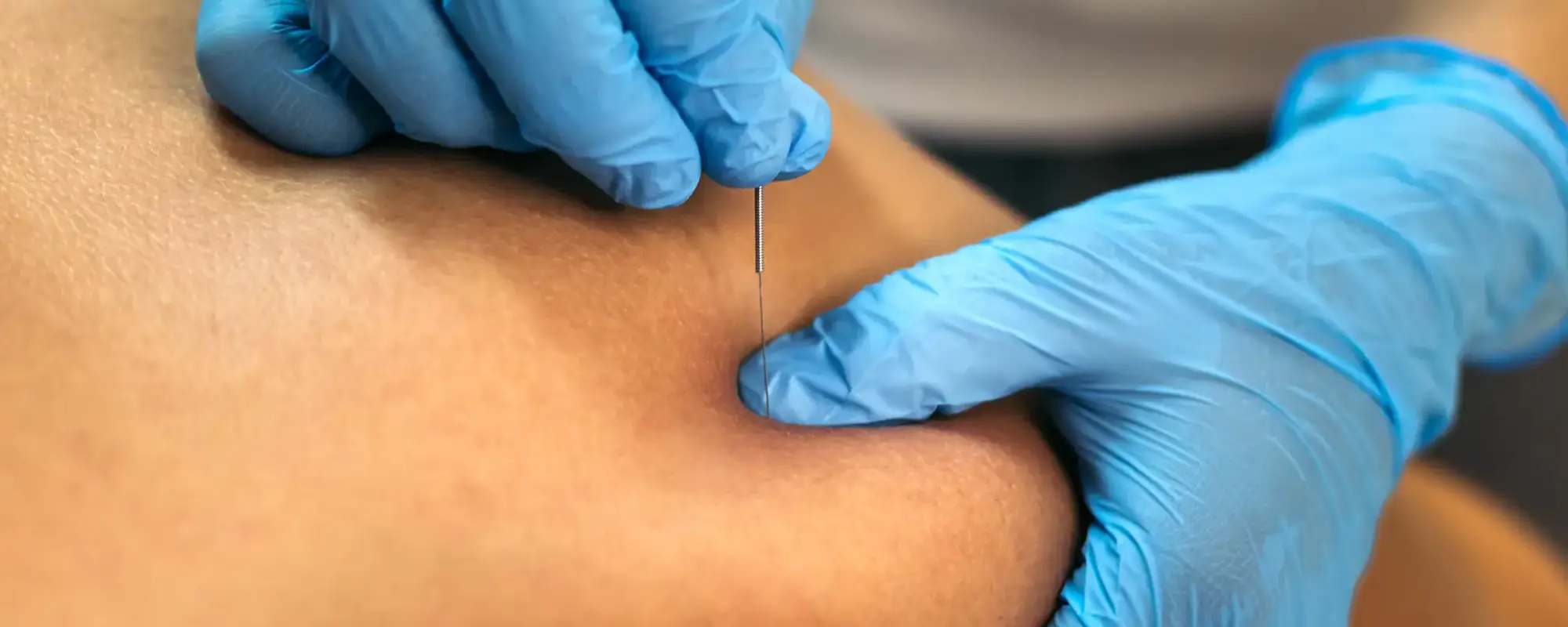 dry needling