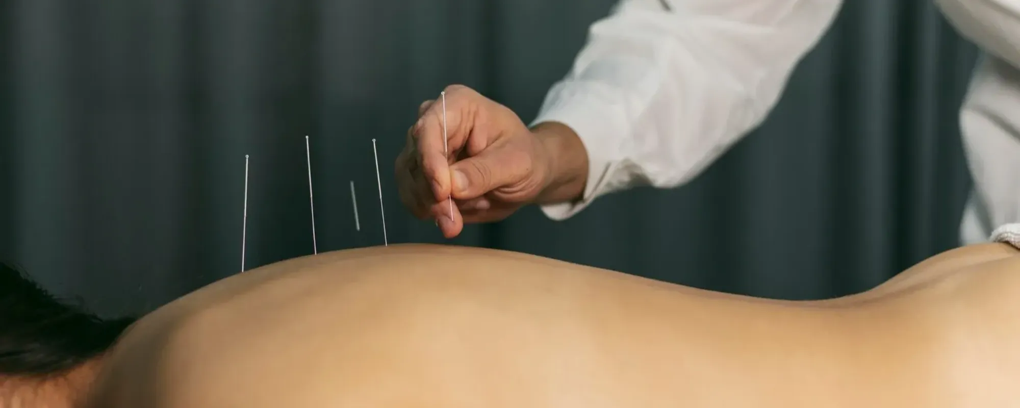 acupuncture-process_23-2148824045 (2)